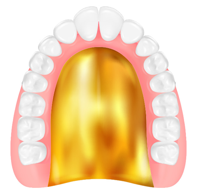 ゴールド床入れ歯