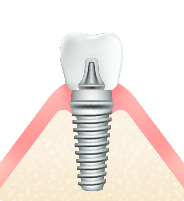 インプラント義歯